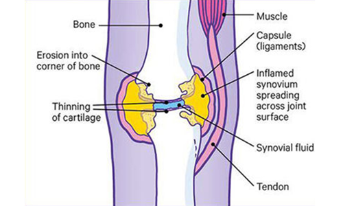 Joint affected by rheumatoid arthritis
