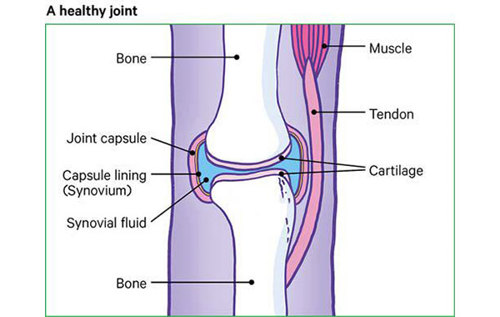 A healthy joint with no damage to the bone, cartilage or synovium.