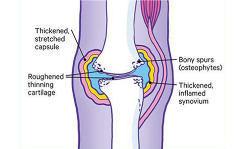 A joint affected by osteoarthritis