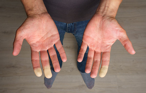 Raynaud's phenomenon: Your questions answered