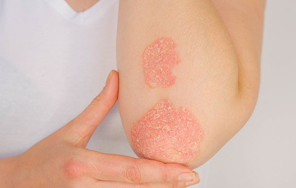 Psoriatic arthritis elbow