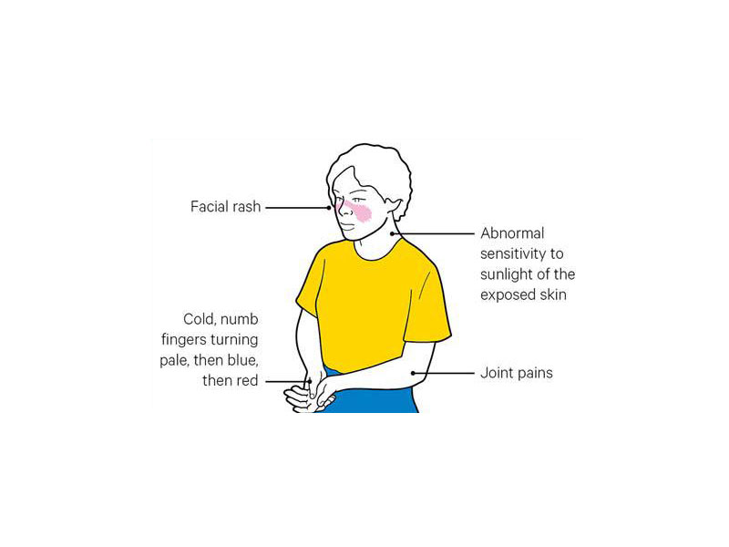 Lupus symptoms
